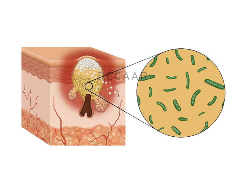 Vi khuẩn P.Acnes phát triển mạnh mẽ